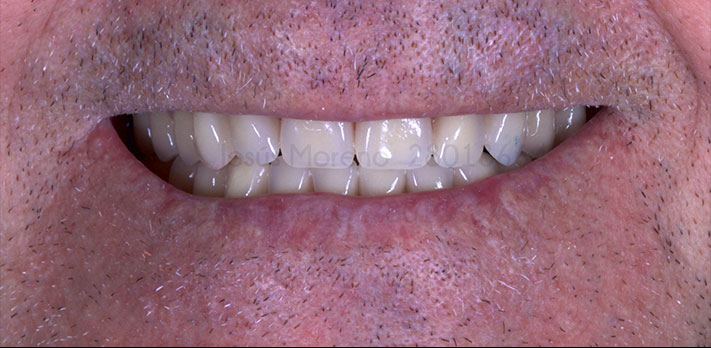 Foto posterior a la Rehabilitación completa con implantes dentales