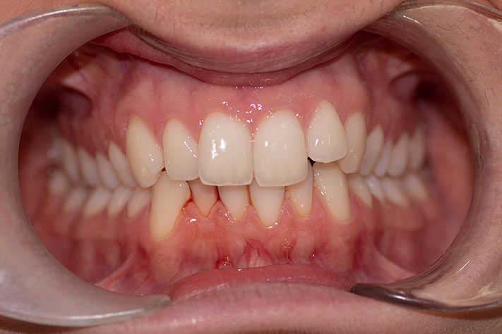 foto inicial antes de tratamiento de ortodoncia invisible