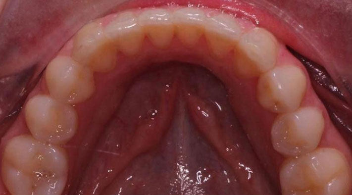 imagen cenital alineación perfecta en ortodoncia