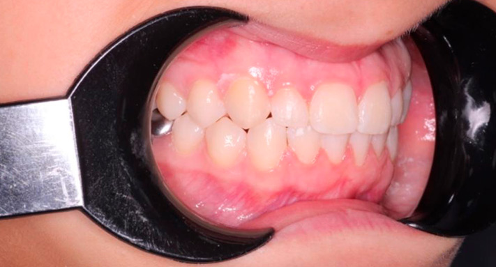 alineación perfecta solucionando apilamiento en ortodoncia