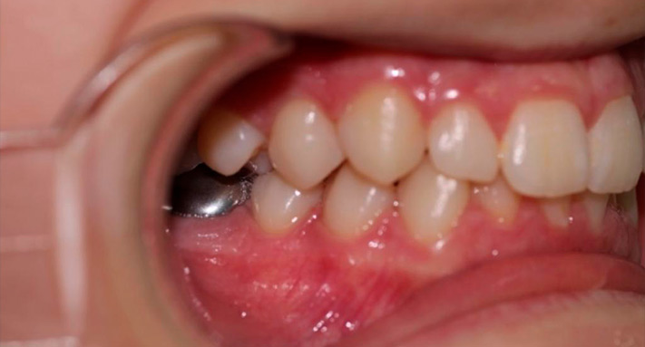 imagen anterior con apilamiento en ortodoncia