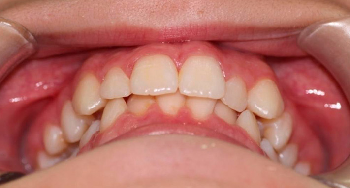 imagen anterior con sobremordida en ortodoncia