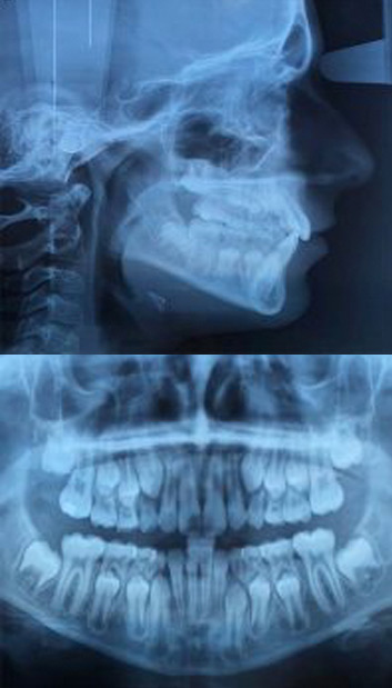 Radiografía tratamiento de Ortodoncia en Móstoles