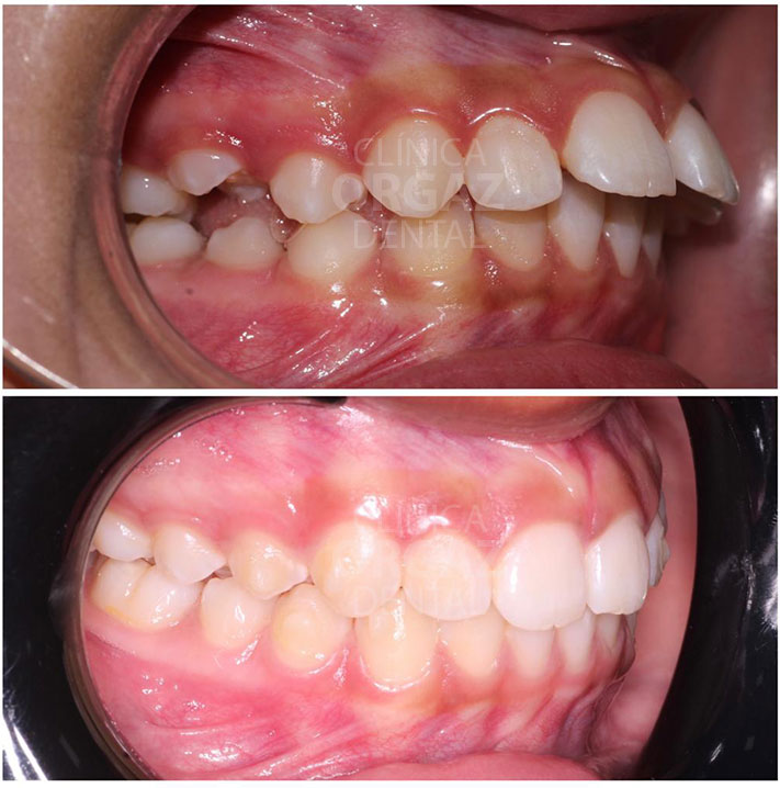 Caso de ortodoncia con mandíbula retraída y problemas de alineación