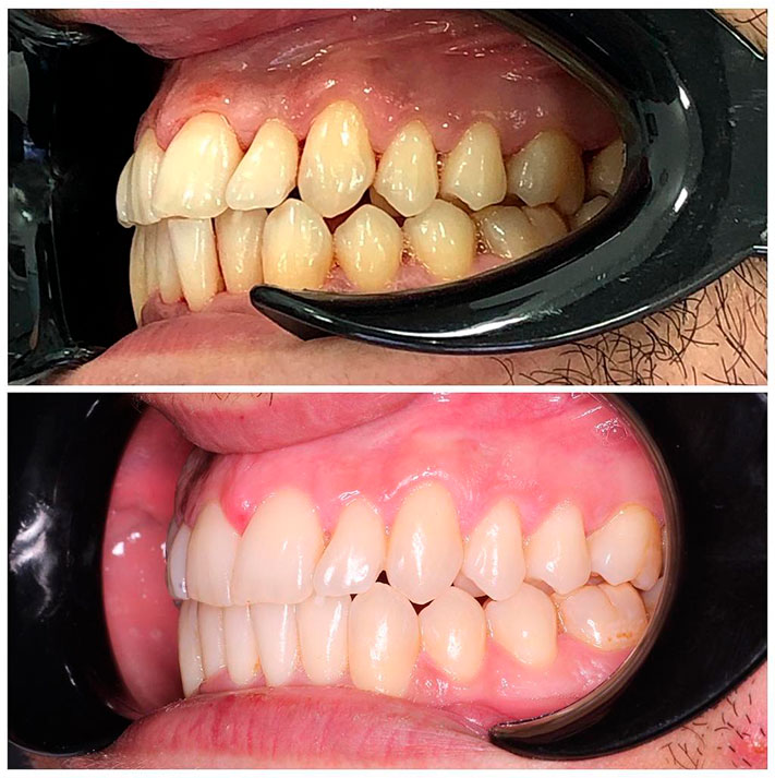 ortodoncia para solucionar apiñamiento leve y sobre mordida