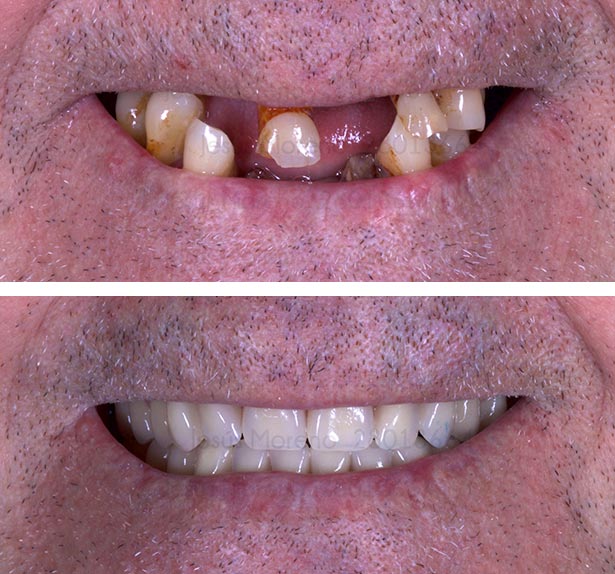 Implantes dentales de carga inmediata en Móstoles