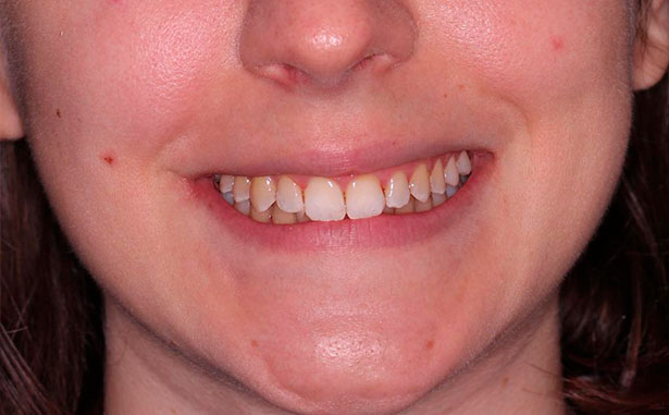 resultado final de tratamiento de ortodoncia para solucionar apilamiento apilamiento severo