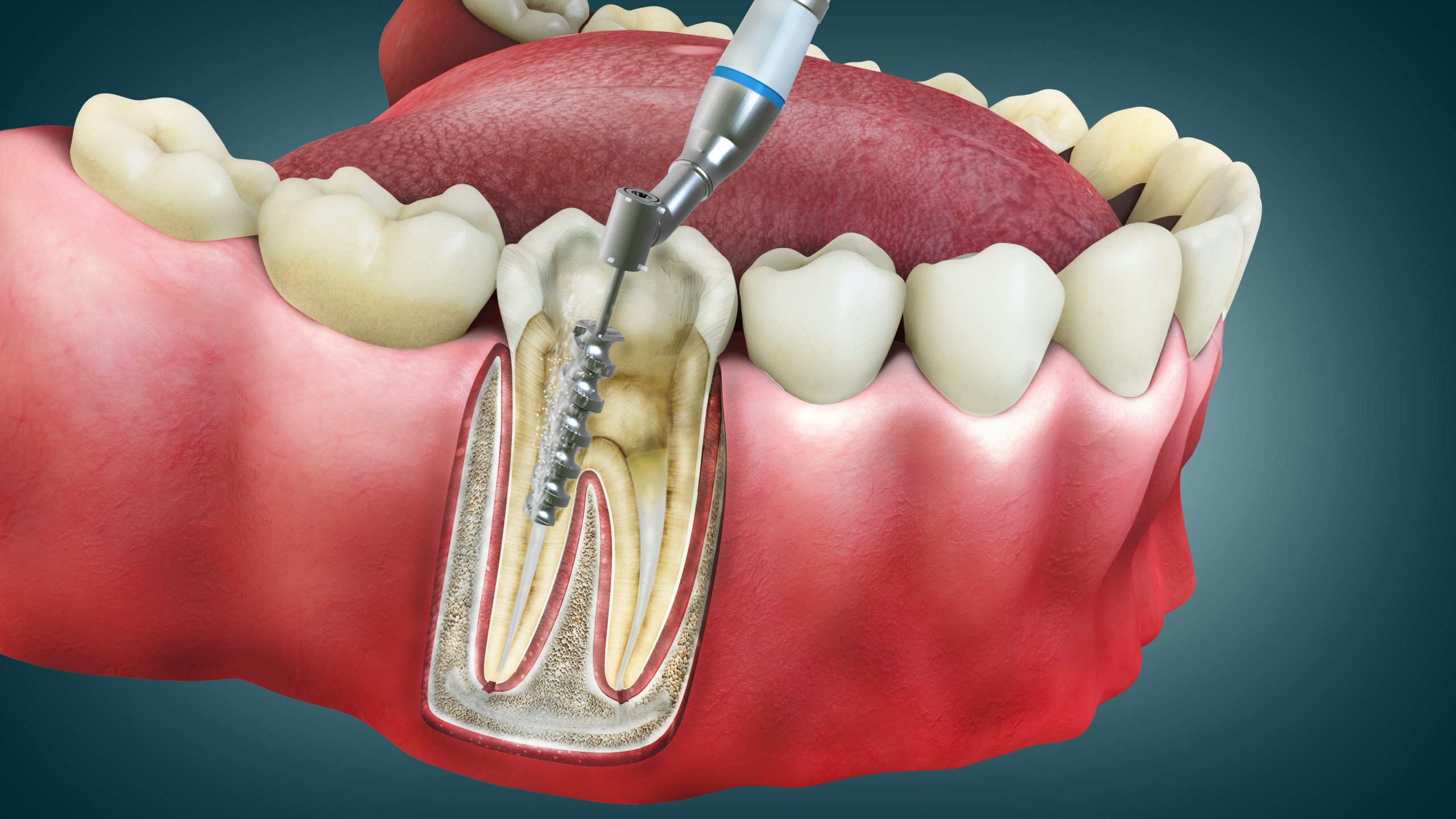 Qué es una endodoncia y cuándo es necesaria