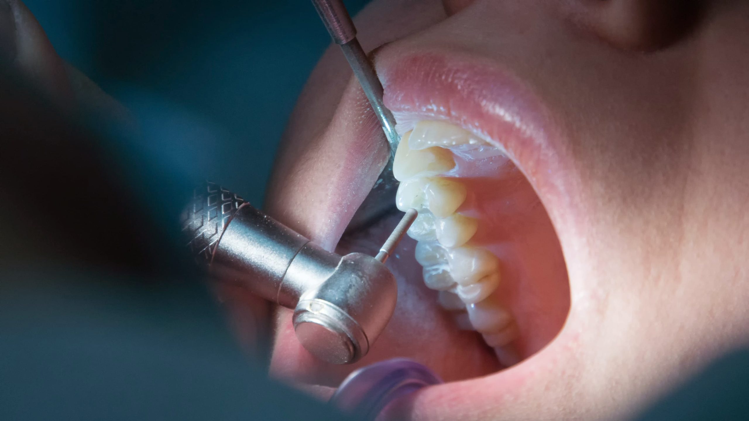 Qué es una endodoncis