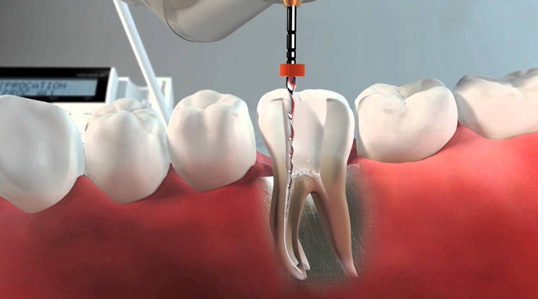 endodoncia cuándo es necesaria