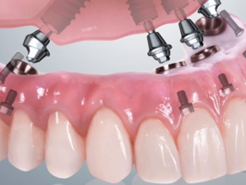 implantes vs dentaduras que es mejor