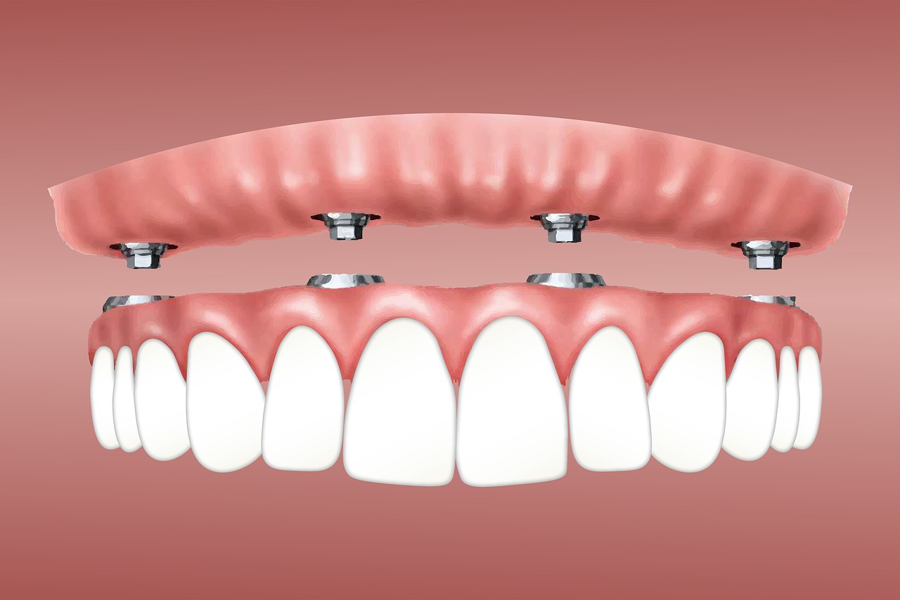 implantes vs dentaduras