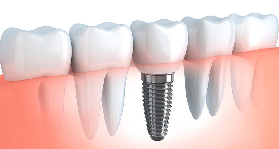 que es mejor implante o dentadura