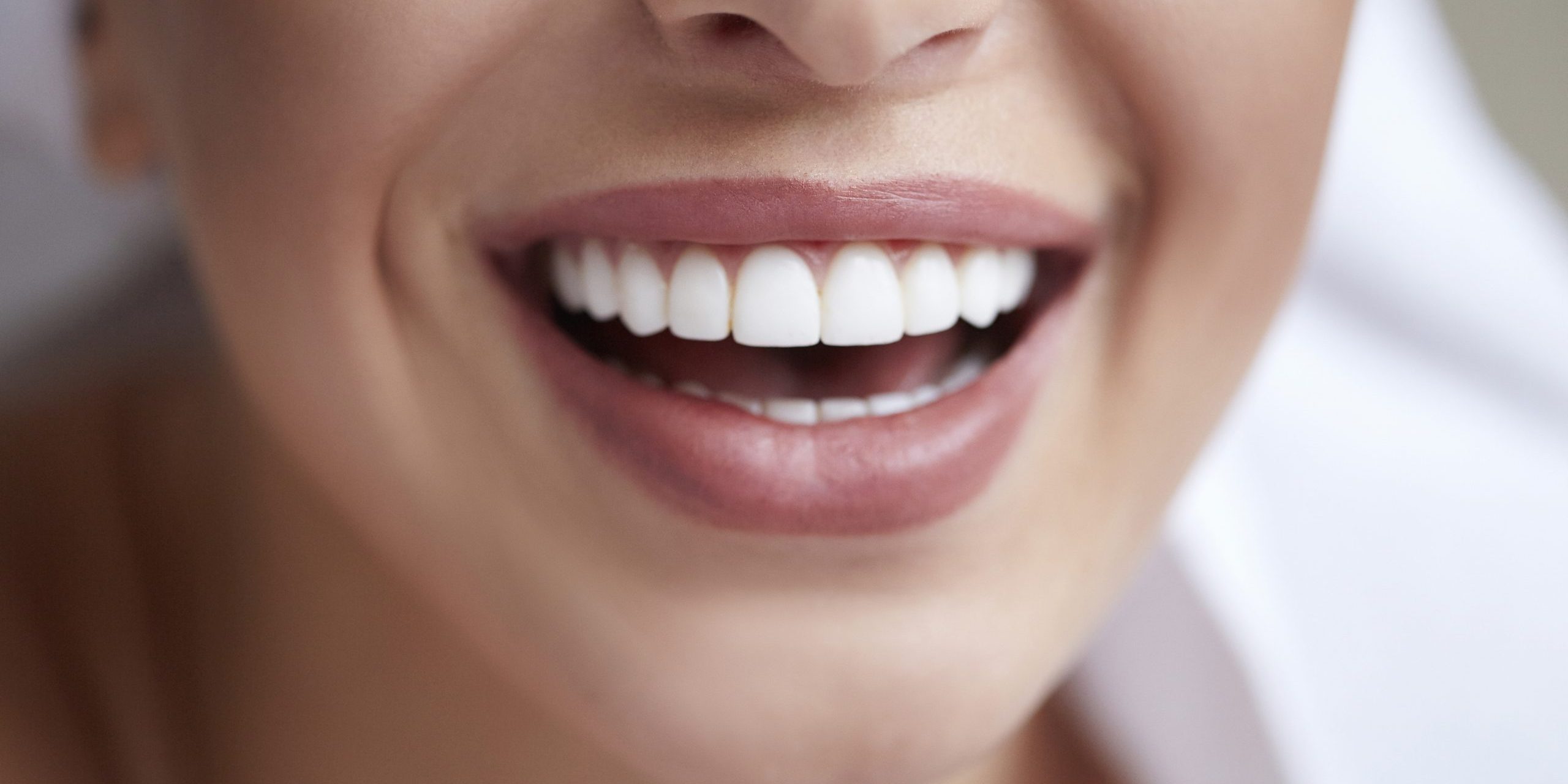 Diferencias carillas y blanqueamiento dental