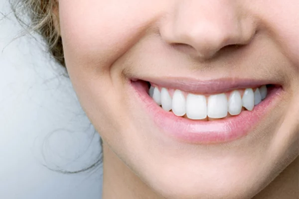 Diferencias entre carillas blanqueamiento dental