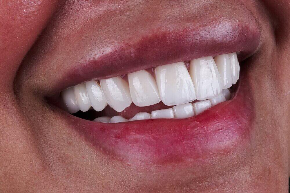 Diferencias entre carillas y blanqueamiento dental
