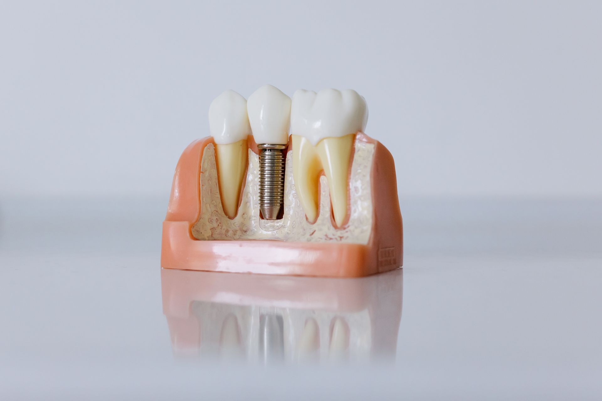 implantes dentales quien puede ponerser