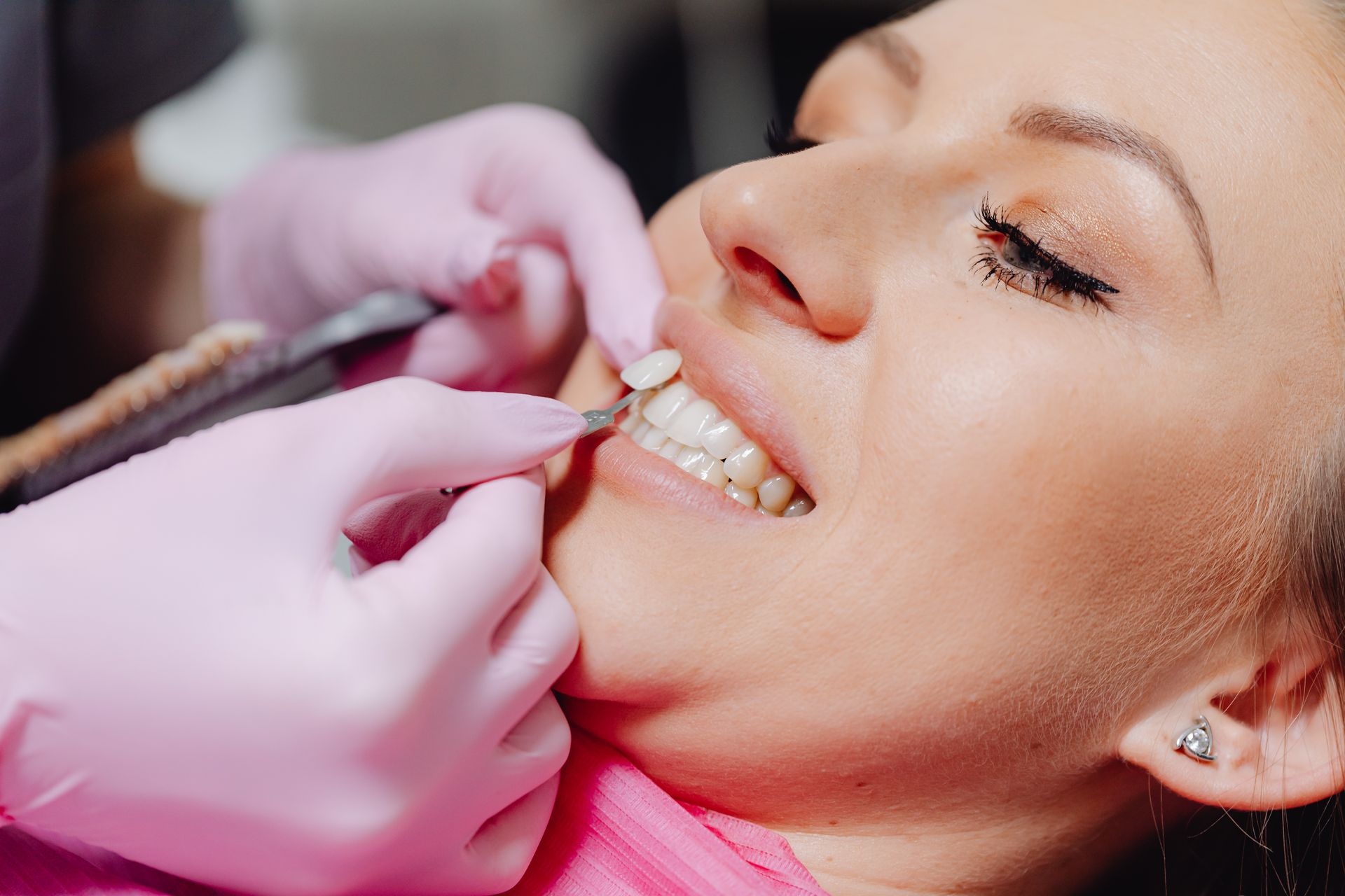 Diferencias entre carillas de composite y porcelana